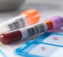 Prostatito laboratorinė diagnozė