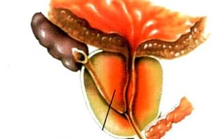 Kas yra vyrų prostatitas