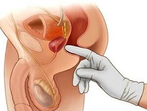 Prostatos masažas vyrų prostatito gydymui