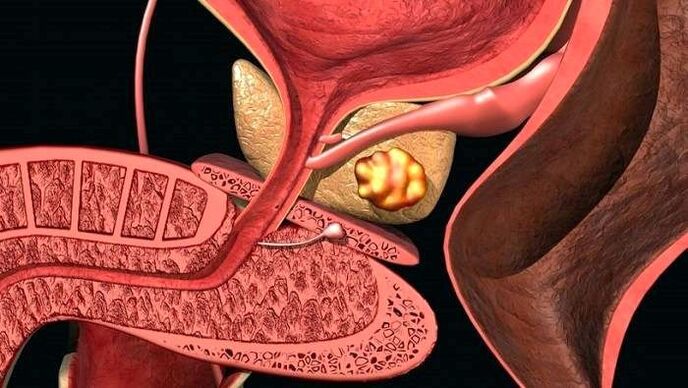 Akmenų nuosėdos prostatoje su kalkuliniu prostatitu