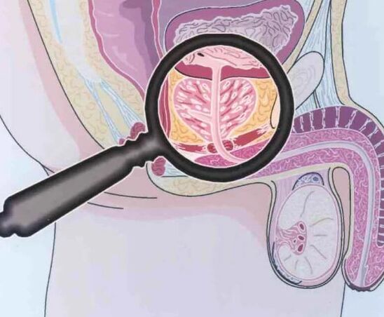 Prostatitas