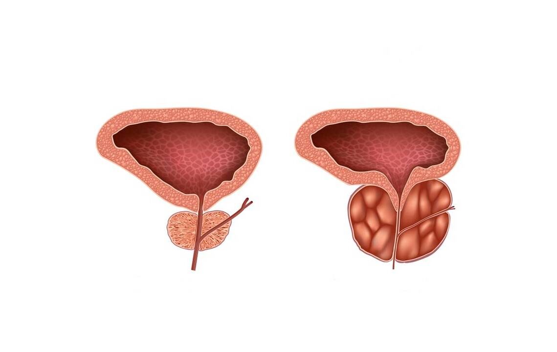 vyrų prostatito simptomai