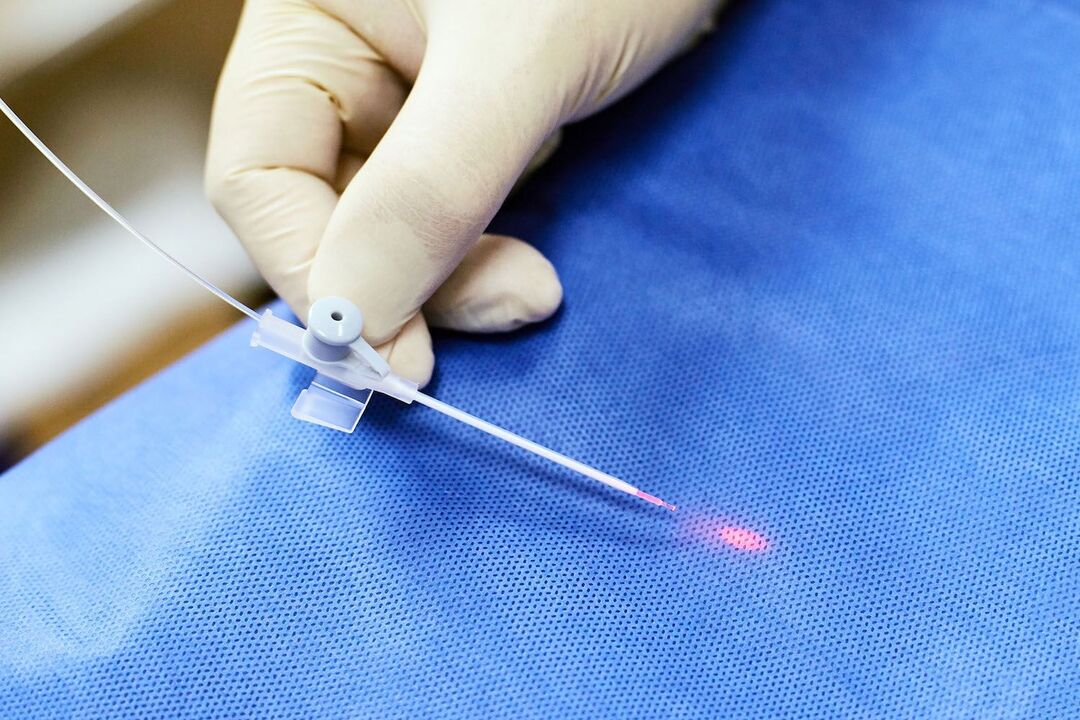 transrektalinis prietaisas prostatos gydymui