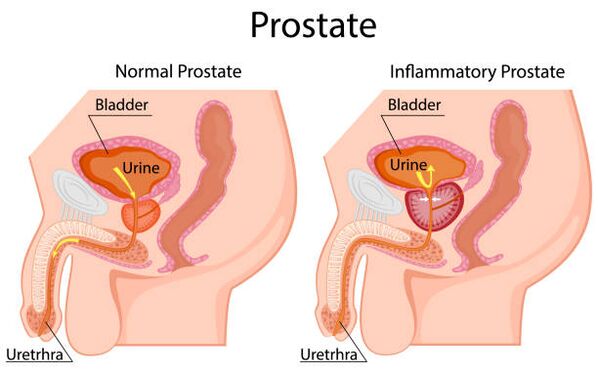 prostatita a prostatei)