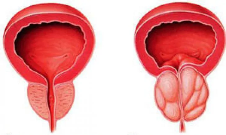 Normali prostata (kairėje) ir uždegiminis lėtinis prostatitas (dešinėje)