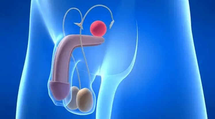 Prostatitas – vyrų prostatos uždegimas, reikalaujantis kompleksinio gydymo